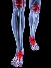 Foot Conditions That May Occur As A Result Of Rheumatoid Arthritis