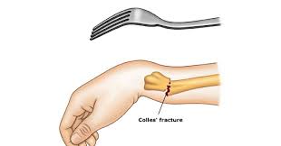 Resultado de imagem para rx com fraturas