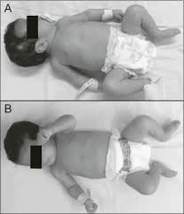 Babies were born infected with syphilis in 2017. Pseudoparalysis Of Parrot A Diagnostic Aid In Congenital Syphilis The Journal Of Pediatrics