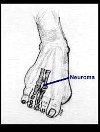 The Cause And Treatment Of Morton S Neuroma