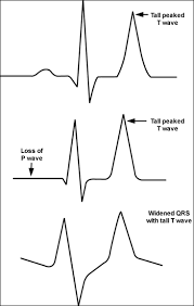 Treat hyperkalemia with one or more of the following: Hyperkalemia American Family Physician