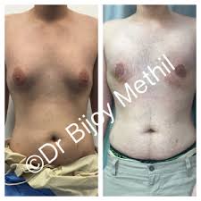 The duration of this operation is about an hour. 10 Things To Know About Gynaecomastia Skin And Shape