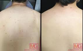You want them running, so they can act as a mask. Back Acne Scars Bacne Treatment In Nyc Dr Michele Green M D