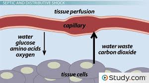 hypovolemic septic shock causes treatment