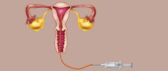 How much does ar viewer development cost? Donor Insemination In Spain How Does It Work