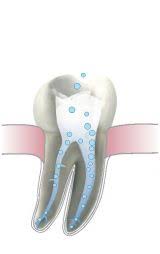 Die wurzelbehandlung ist ein zahnmedizinischer eingriff, bei der ein entzündeter zahnnerv chirurgisch entfernt wird. Endotonie Wurzelkanalbehandlung Zahnarzt In Pforzheim Nordstadt Dr Brebeck