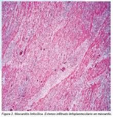 Viral infection is the most common cause of myocarditis. Miocarditis Linfocitica Por Tripanosoma Reporte De Un Caso