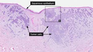 Learn more on advanced detection and treatments. Dictionary Cancer Skin Cancer The Human Protein Atlas