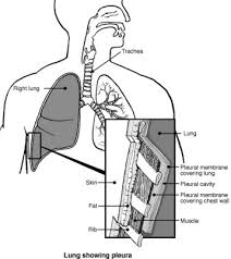 Cancer occurs initially on the parietal surface and several pathogenetic mechanisms have been proposed (5): Asbestos Related Diseases Asbestos Lung Diseases Patient