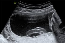 Bin jetzt verunsichert, weil ich nicht genau weiß ob. Feindiagnostik Organschall Praxis Fur Pranatale Diagnostik