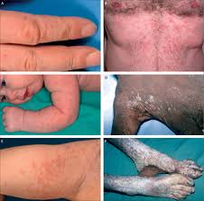 Image result for scabies human children