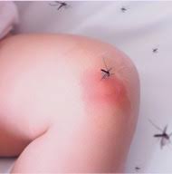 Image result for Papular urticaria