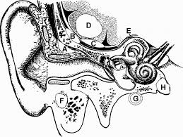 Image result for Mastoiditis