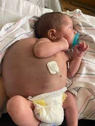 My nephew is born with Arthrogryposis he is 3 months old and during recent visit to his doctor he said he do not have 5 vertebrae and his thigh born is not