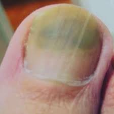 Nagelveranderungen Deuten Sie Die Anzeichen Fur Langs Und Querrillen Richtig Gesundheit