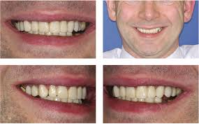 Treating tooth wear: a step-by-step explanation