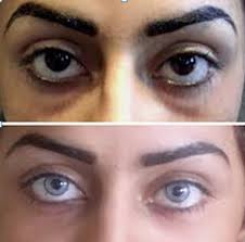 Goz Rengi Degistirme Ozel Veni Vidi Goz Sagligi Merkezi