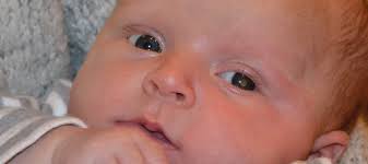On rare occasions, it can occur on the outermost layer on the front of the eye (the conjunctiva), in the socket that surrounds the eye, or the eyelid itself.﻿﻿ What Is Retinoblastoma Childhood Eye Cancer Trust