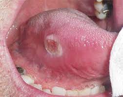 As you review these images and their descriptions, you. Oral Cancer Symptoms Diagnosis Treatment Carson Carson Dds