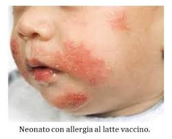 L'interesse che ruota intorno alla tematica ha registrato negli ultimi anni un aumento costante, non soltanto da parte di medici e studiosi ma anche di tutti i profili che operano e interagiscono nel settore dell'alimentazione. Allergie Ed Intolleranze Alimentari Roma Gastroenterologo Dott Prof Antonio Iannetti