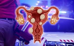 Fibroid rahim dapat muncul di dalam rahim ataupun di dinding rahim. Fibroid Ketumbuhan Paling Kerap Berlaku Pada Rahim Yang Boleh Membahayakan Iluminasi
