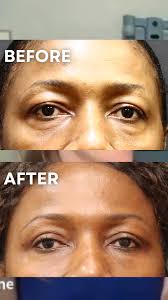 Why do top NYC doctors Dr. Jody and Elie Levine love fat grafting for  hollowed lower eyes?, ✅Minimally Invasive, ✅Permanent, ✅Rejuvenating, Check  out this episode & more of Beyond The Scalpel -- ...