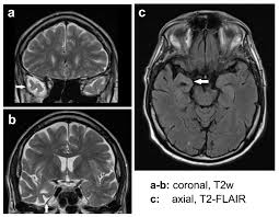 Image result for Progressive Bulbar Paralysis