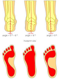 What could cause both feet to be painful and swollen for a whole month? Foot Pain Along The Outside Of The Foot Causes Best Home Treatment