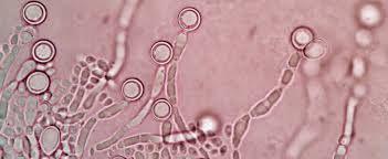 El propósito de este estudio es determinar si la adición del medicamento, deferasirox, a la terapia antifúngica estándar para la infección, la mucormicosis, es segura y eficaz. Laboratorio De Micologia Home Facebook