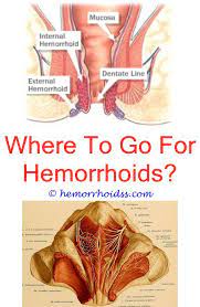Can You Get Rid Of Hemorrhoids What To Do If Hemorrhoids Cause Bleed A Lot Do Internal Hemorrhoids Obst Hemorrhoids Hemorrhoid Remedies Hemorrhoids Treatment