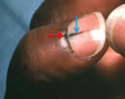 Check spelling or type a new query. Normal Black Line Under Fingernail Vs Melanoma Streak Scary Symptoms