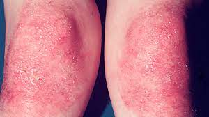 Dermatomyositis Causes Symptoms And Treatment What do you know about antibiotics?