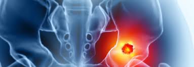 Image result for Chondrosarcoma