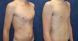 It is also known as pigeon chest or keel chest. Pectus Carinatum Case Histories