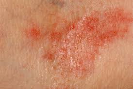 Image result for Eczema nummulare