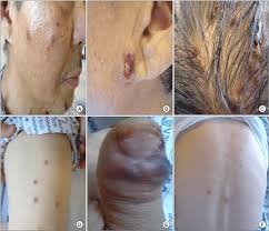 Image result for Pyoderma Gangrenosum