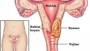 Kansere neden olan hpv virüsü erkeğe bulaşabilir ve erkekte siğil (kondilom) oluşumuna neden olabilir. Rahim Ve Yumurtalik Kanseri Cinsel Yolla Bulasir Mi Nereye