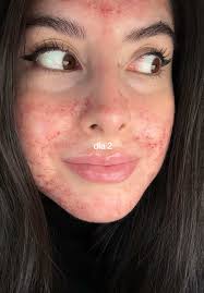 Experiência com Laser Fotona para Tratamento de Acne