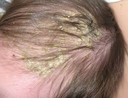 Image result for dry scabs on the head in children