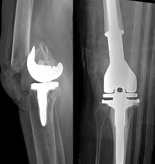 Geriatric Femur Fractures Upmc Physician Resources