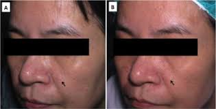 The condition is characterized by the development of a however, if choosing to look for treatment options, the best route would depend largely on the symptoms that accompany the condition. Using Pulsed Dye Laser To Treat Sebaceous Hyperplasia Comparison Of Short And Long Pulse Duration Pulsed Dye Laser Sciencedirect