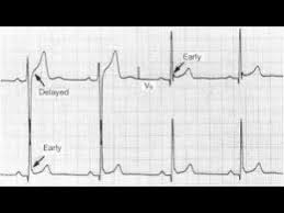 Image result for Early Repolarization