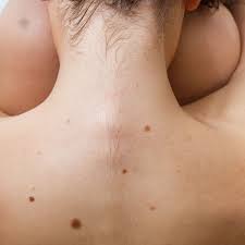 How To Stop Getting Acne On Your Neck