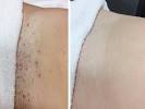 Before And After Ingrown Go