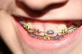 Purple Light Orange And Neon Yellow Brackets Dentales Brackets Consejos De Apoyo