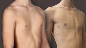 Wann senkt sich die brust nach einer brustvergrößerung? Trichterbrust Ein Loch In Der Brust Kann Psychisch Belastend Sein