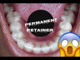 We did not find results for: How To Clean A Permanent Retainer After Braces Youtube