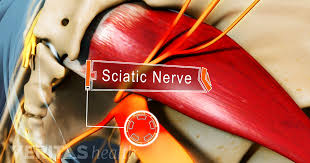 A pinched nerve can occur due to pressure build up around the nerve. What You Need To Know About Sciatica