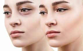 Augenringe Augenschatten Asthetische Dermatologie In Wien Dr Barbara Franz