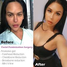 Make Your Face More Feminine In Korea In 2020 Facial Contouring Facial Feminization Surgery Forehead Reduction